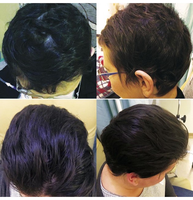 Sistema Capelli - Reduz a queda de cabelo na quimioterapia